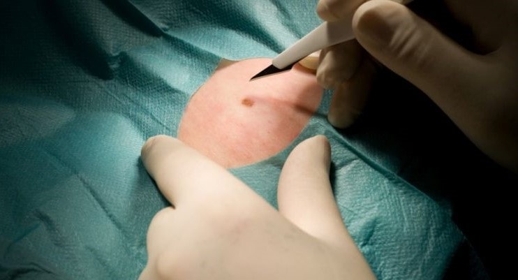 Chirurgia Dermatologica Ambulatoriale genova