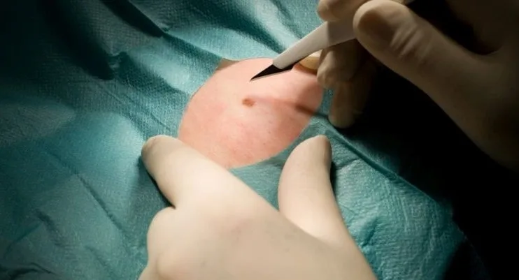 Chirurgia Dermatologica Ambulatoriale genova