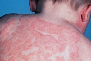 dermatite eczematosa