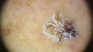 cheratosi attinica cura