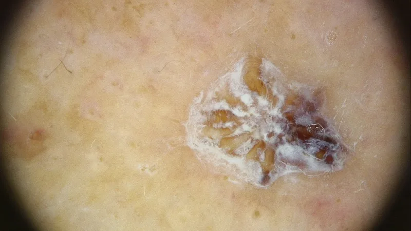 cheratosi attinica cura