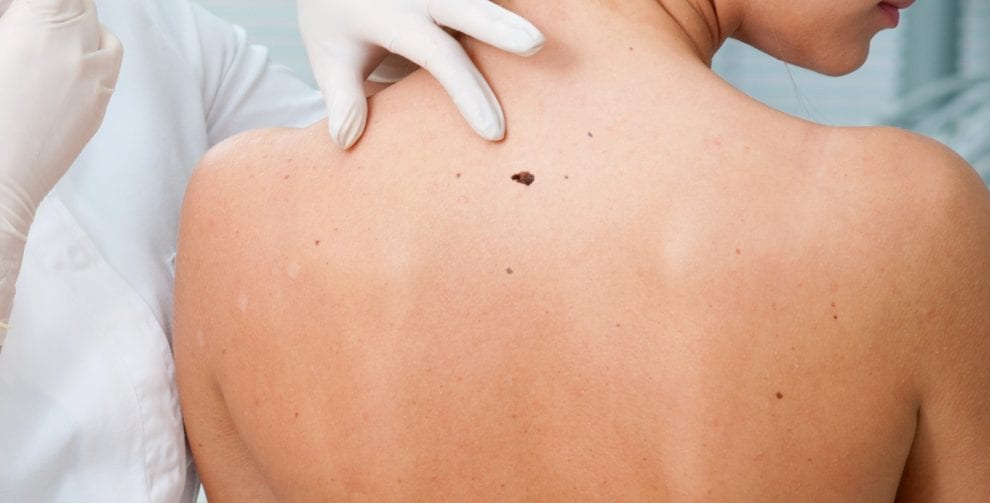 Etapas del cáncer de piel tipo melanoma