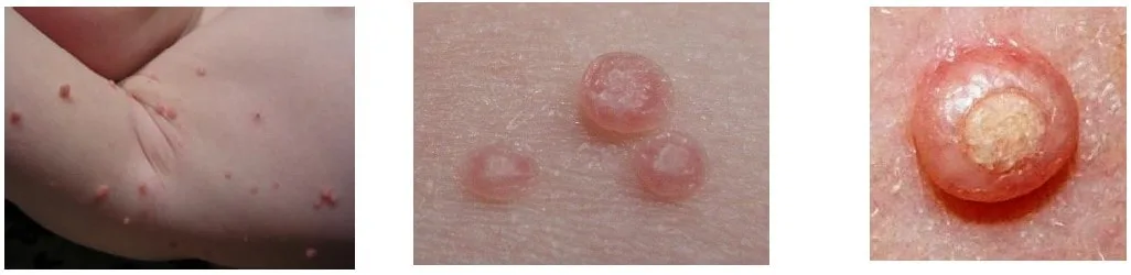 virus mollusco contagioso