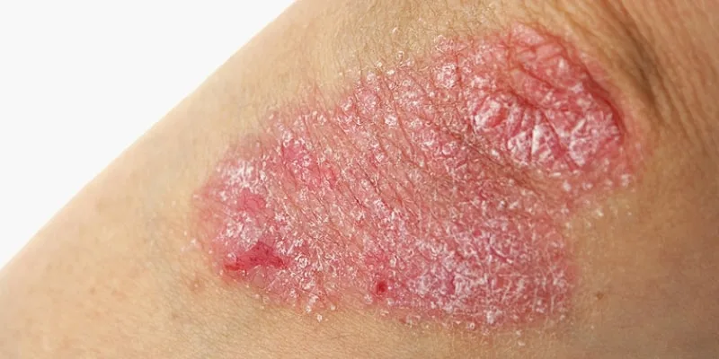 psoriasi cura